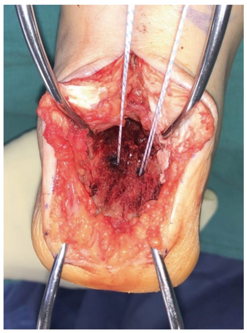 Якорная фиксация