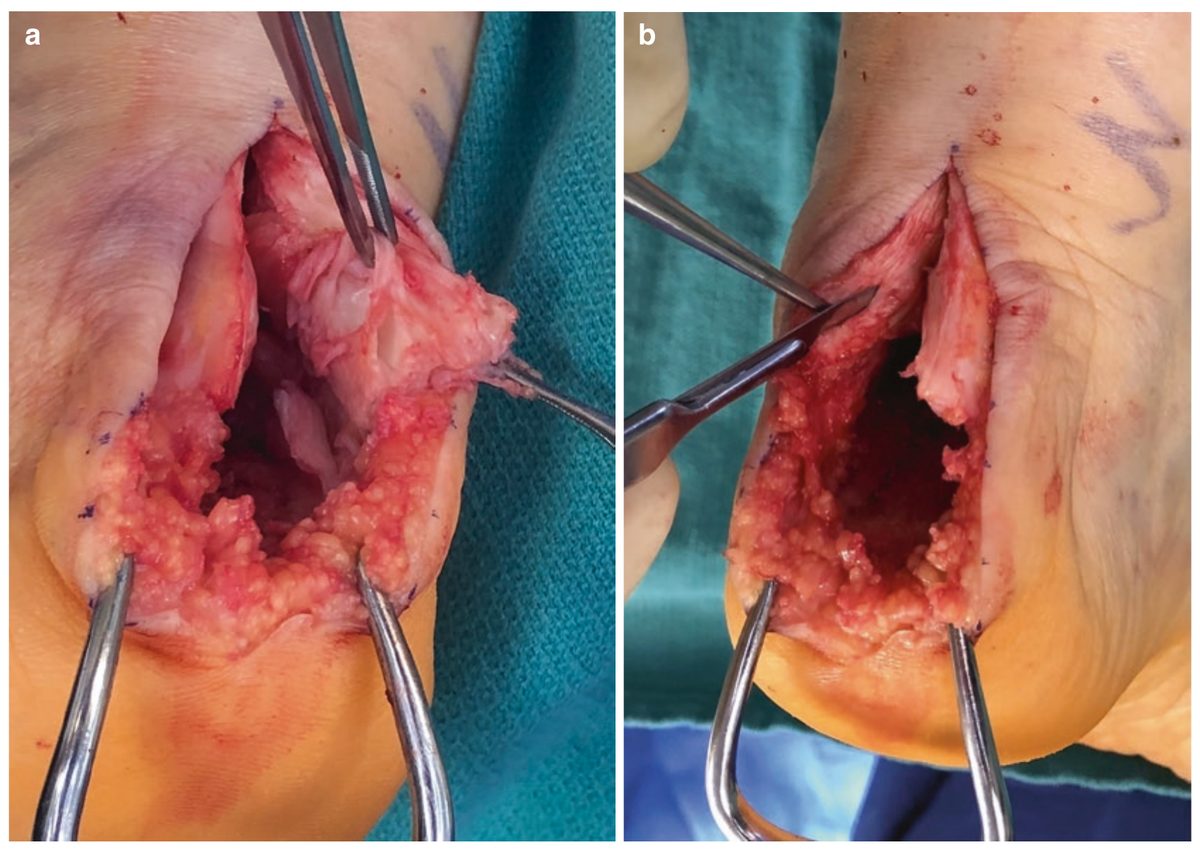 Дебридмент дегенеративного сухожилия
