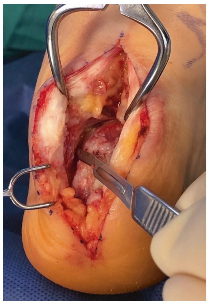 Частичное отсечение инсерции сухожилия