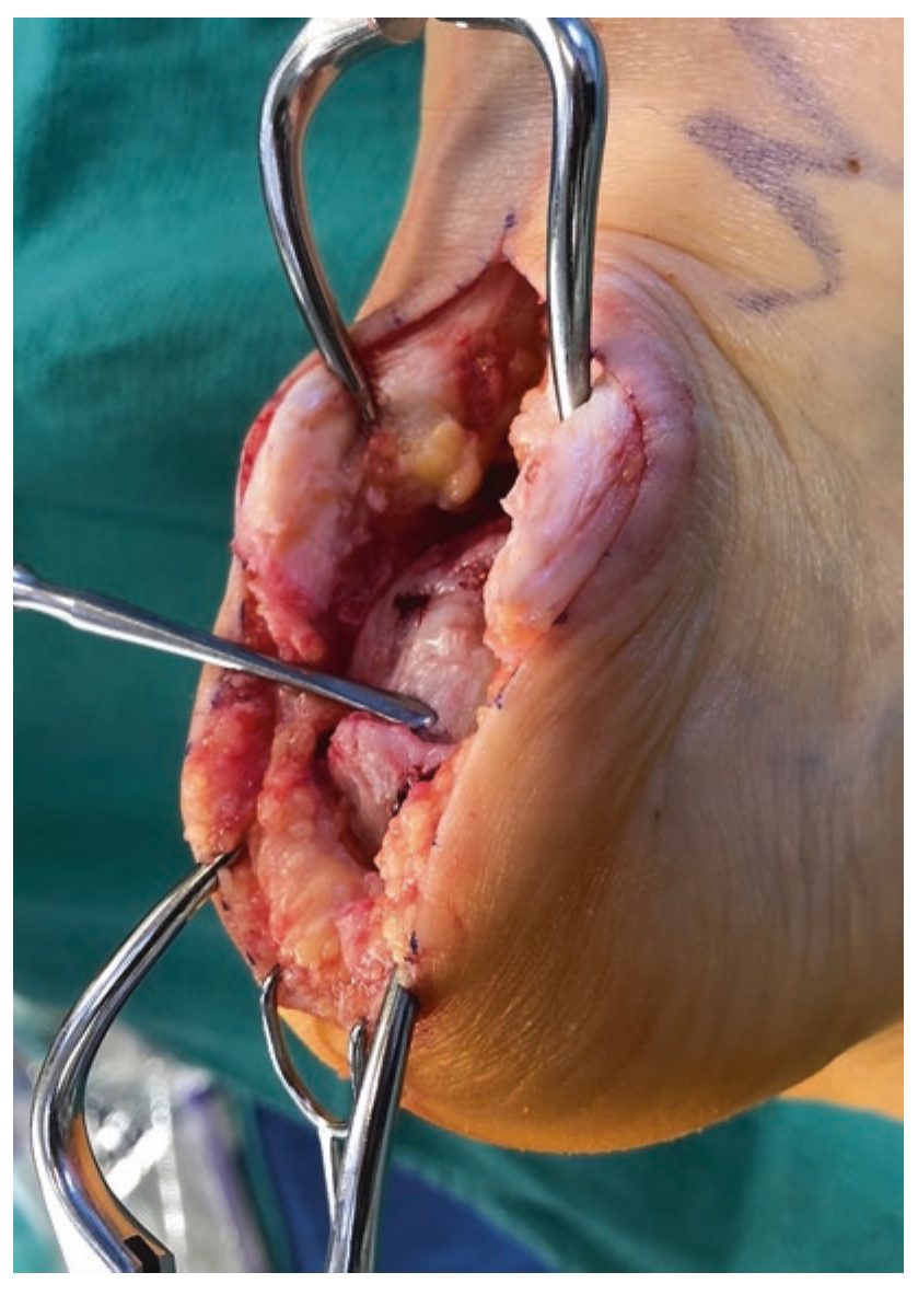 Локализация энтезофита