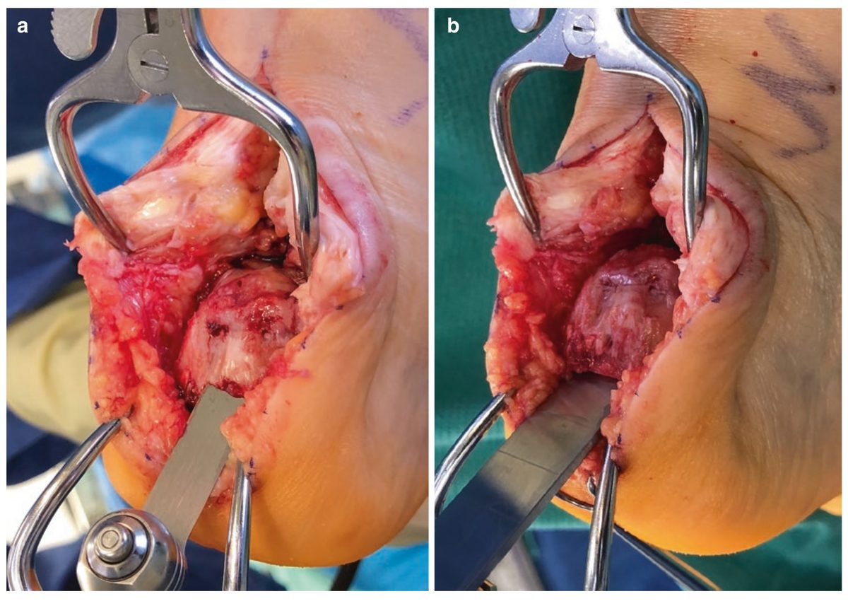 Экзостэктомия деформации Хаглунда