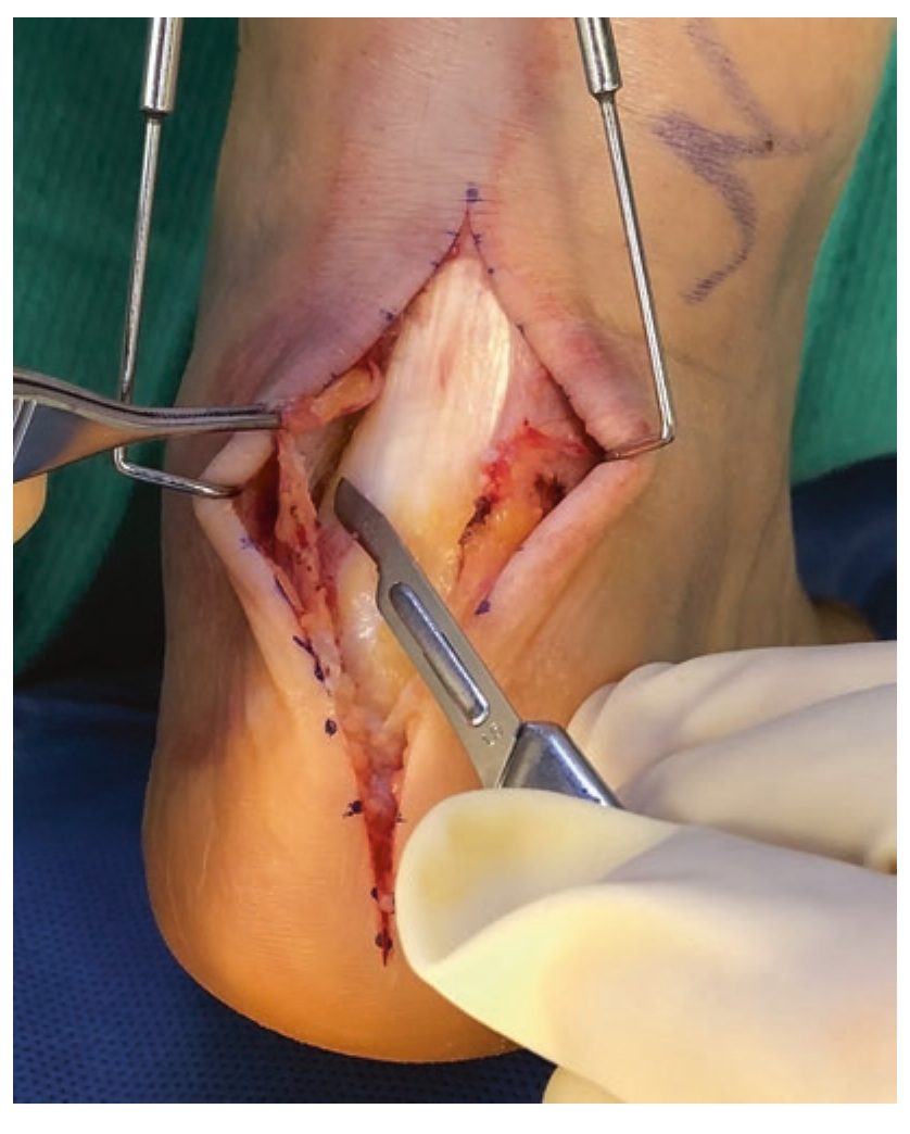 Рассечение паратенона