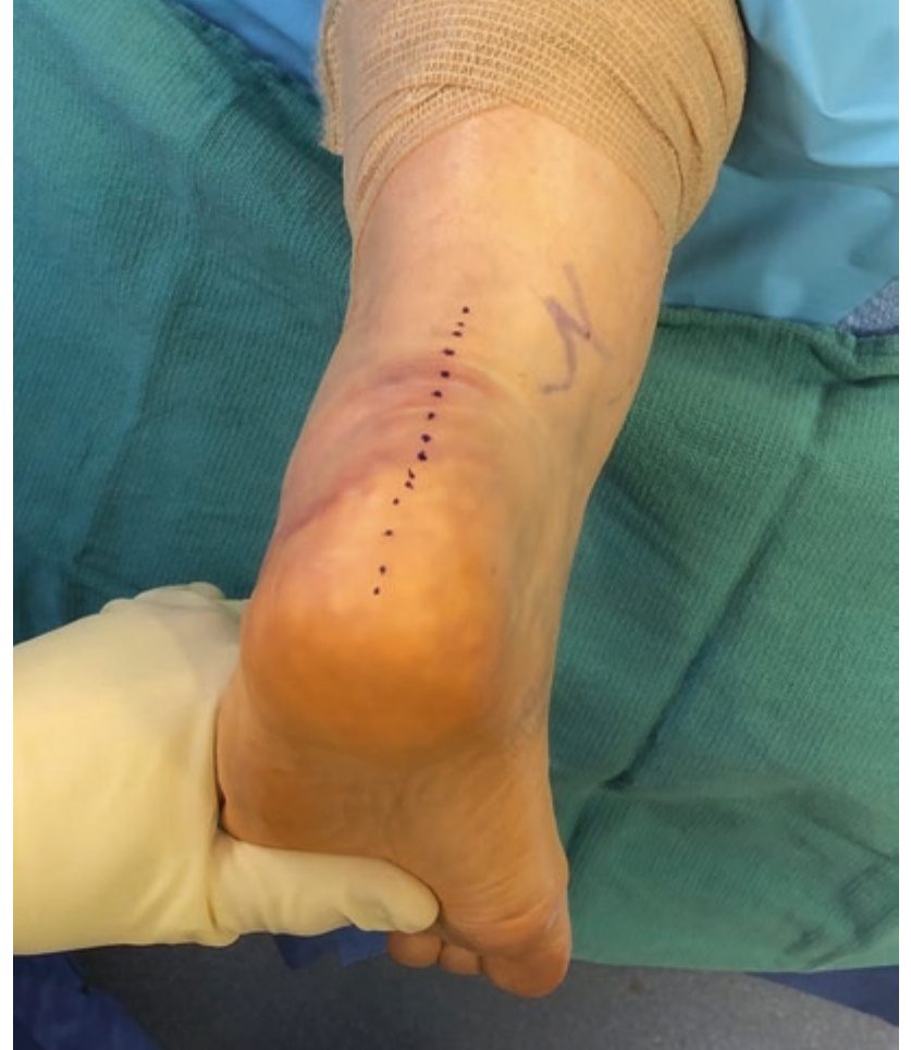 Позиционирование пациента и разметка разреза