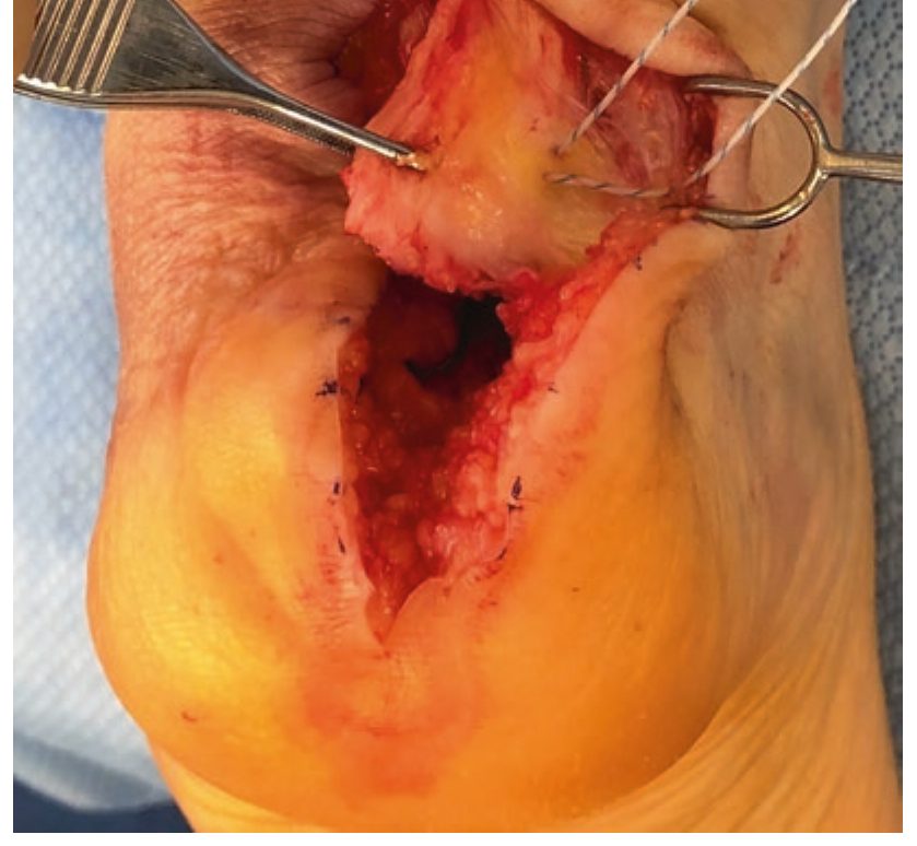 Реинсерция ахиллова сухожилия