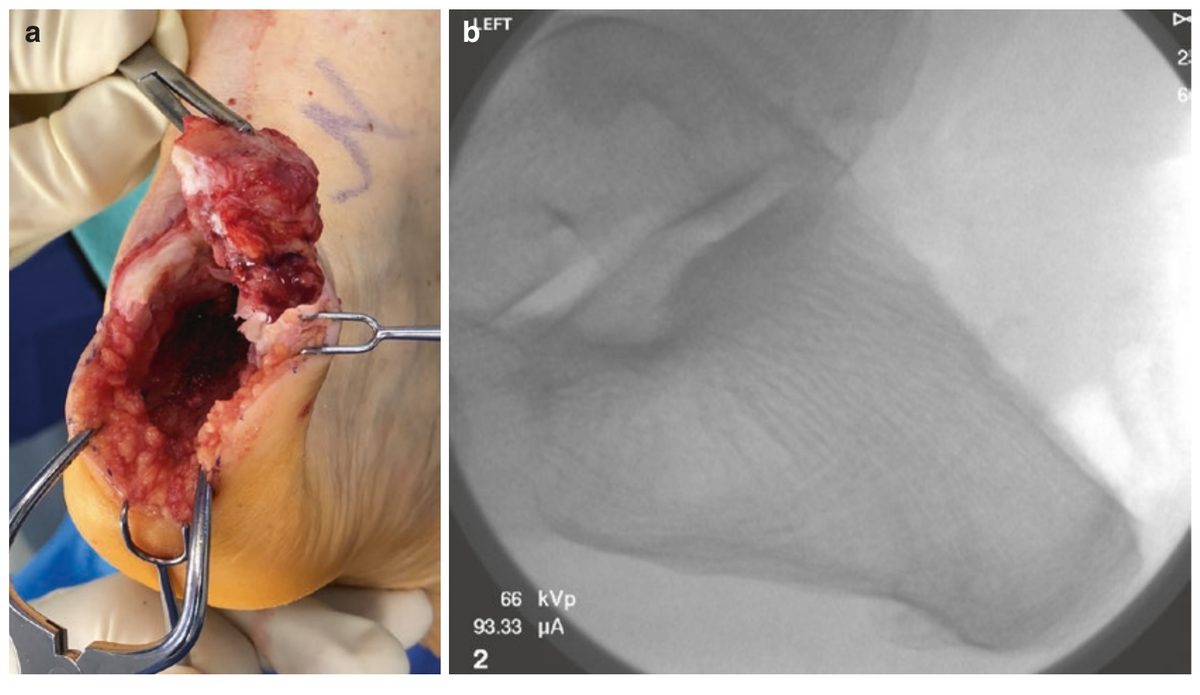 Резецированный фрагмент и флуороскопия