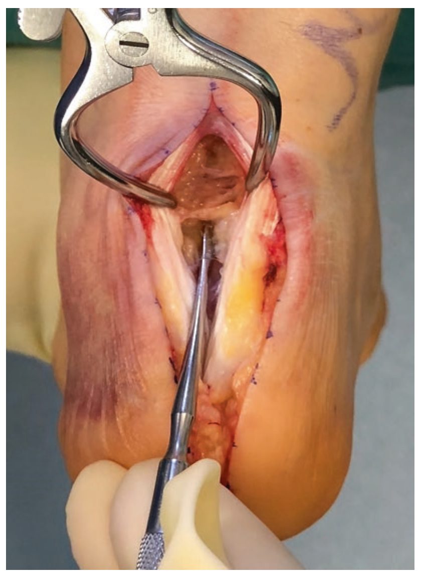 Продольное расщепление сухожилия