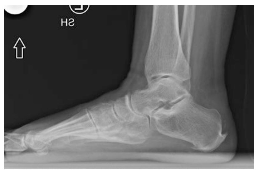 Боковая рентгенограмма — энтезофит и деформация Хаглунда