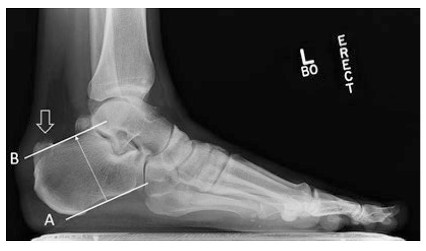 Рентгенометрия деформации Хаглунда