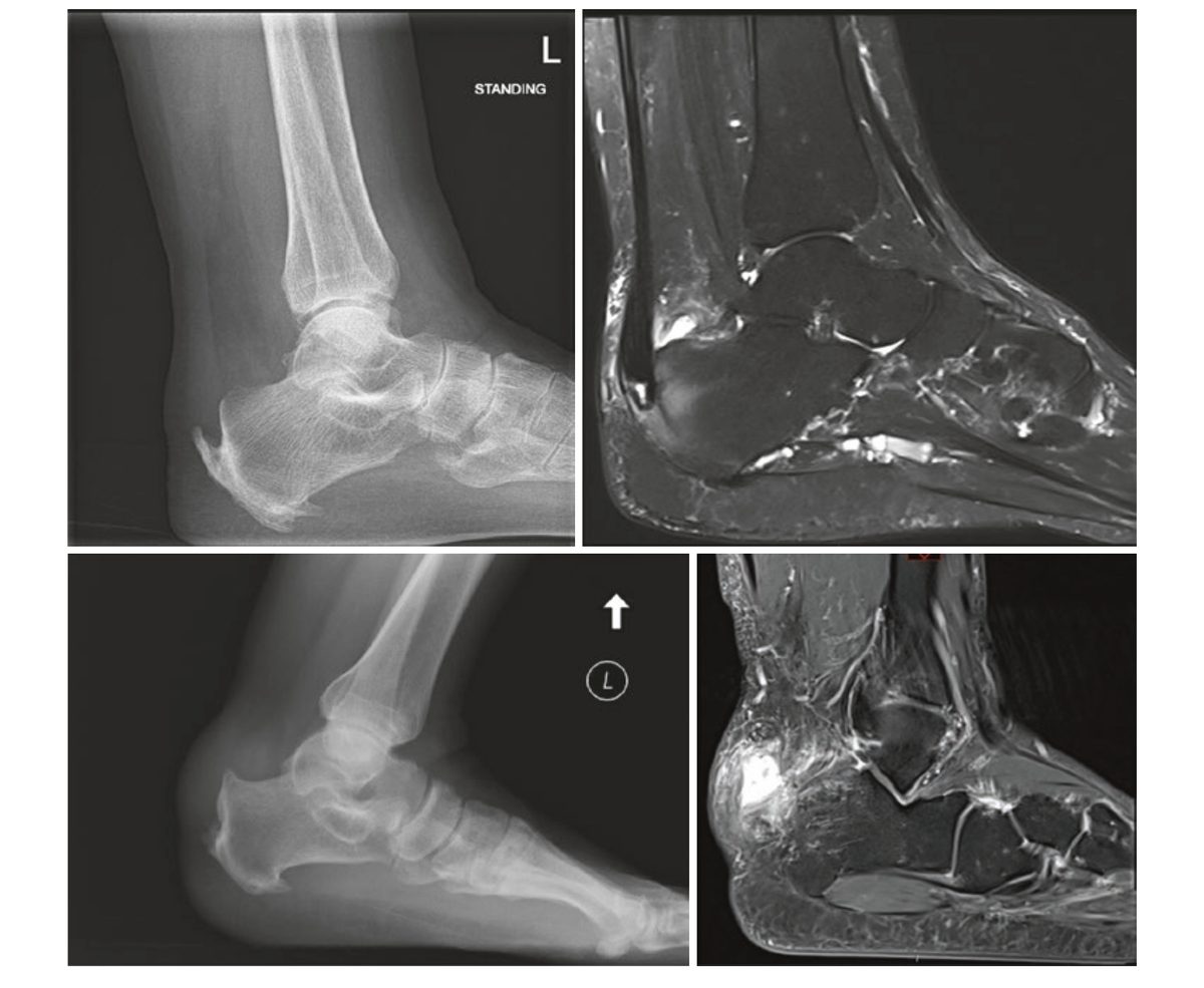 Хроническая инсерционная тендинопатия — рентген и МРТ