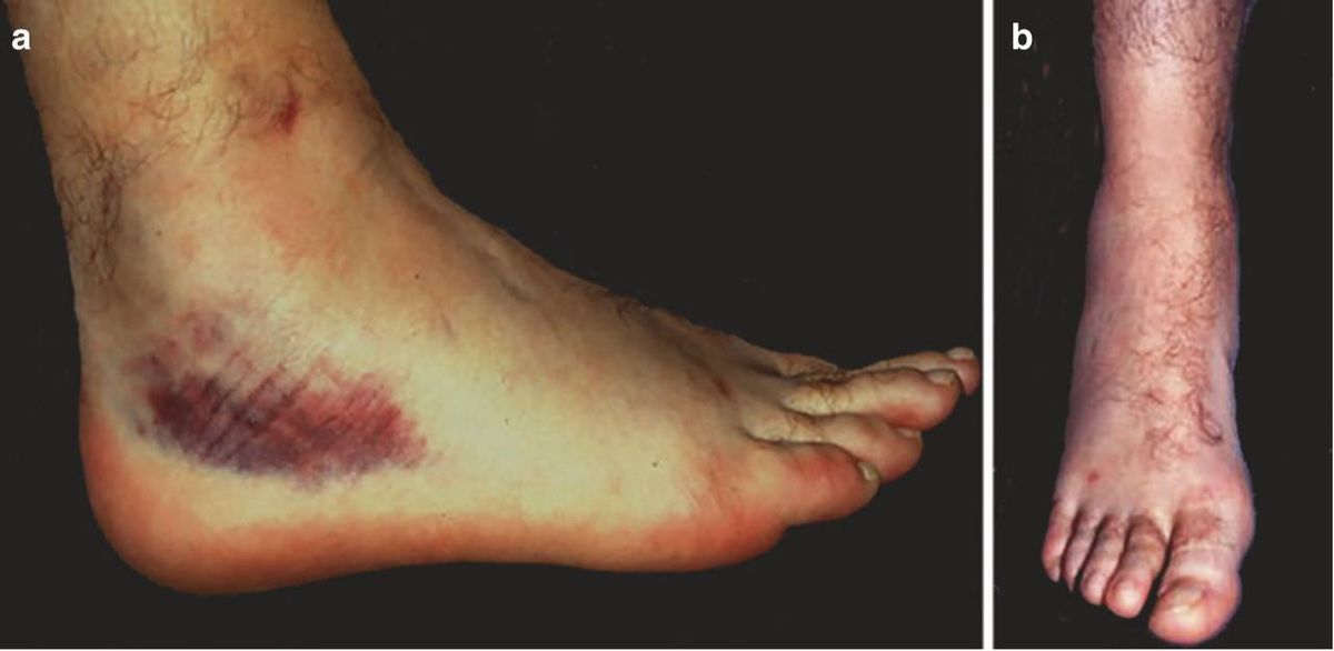 Отёк и экхимоз после острого растяжения