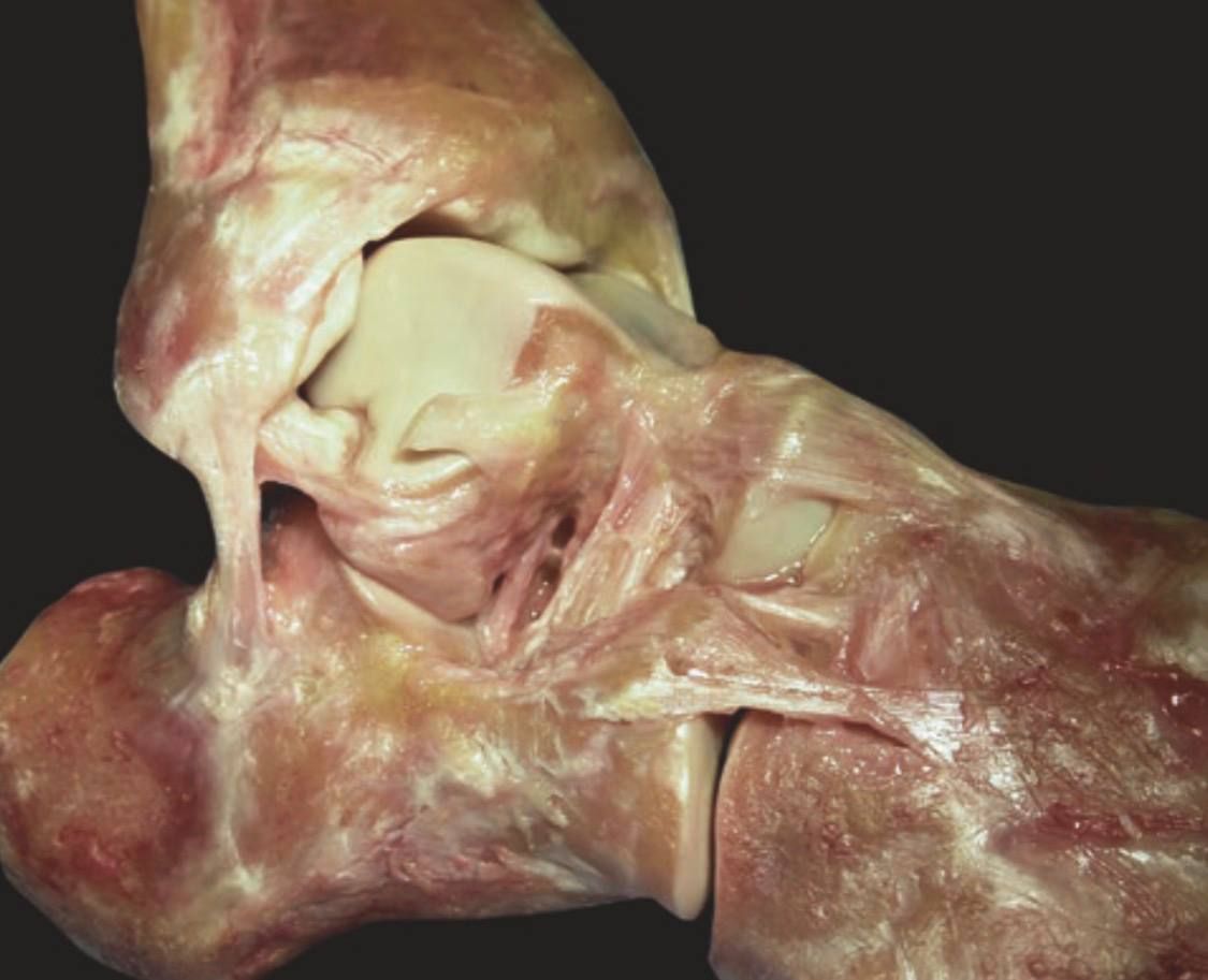 Переднелатеральная ротационная нестабильность