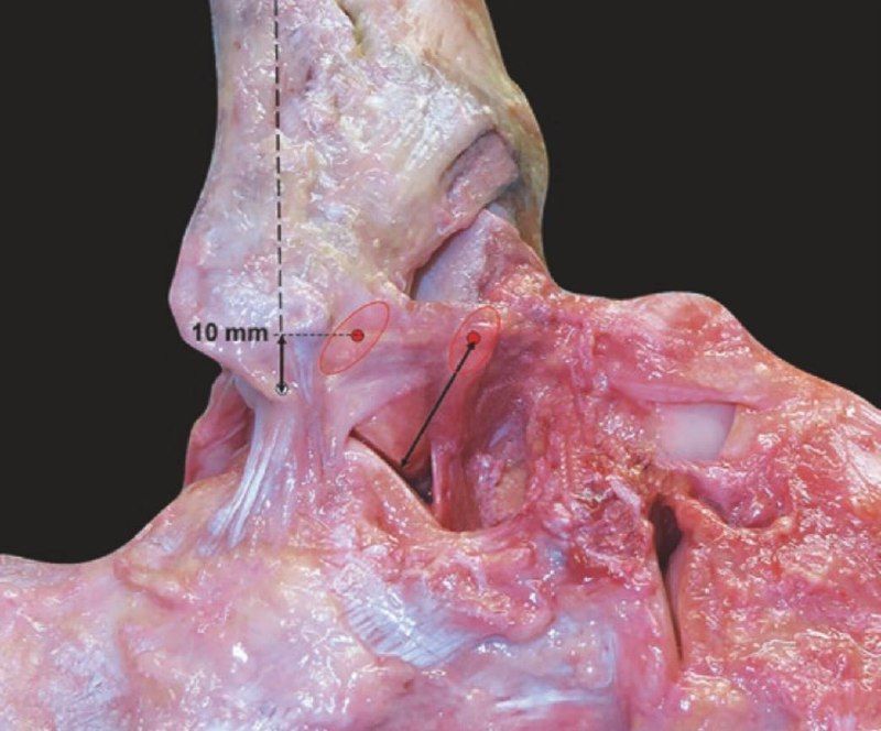 Передняя таранно-малоберцовая связка (ATFL)