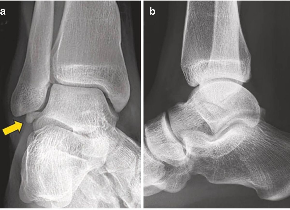 Отрывной перелом латеральных связок — рентгенограммы
