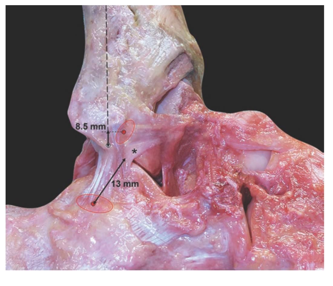 Пяточно-малоберцовая связка и латеральная таранно-пяточная связка