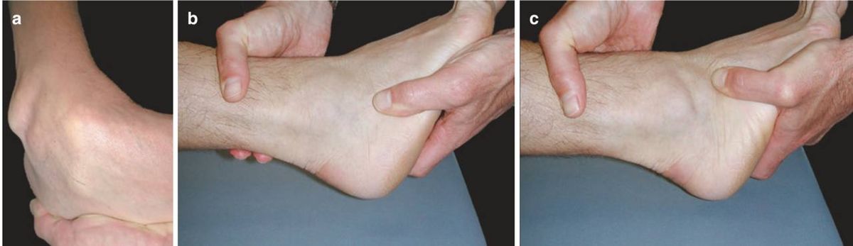 Симптом ямки (dimple sign)