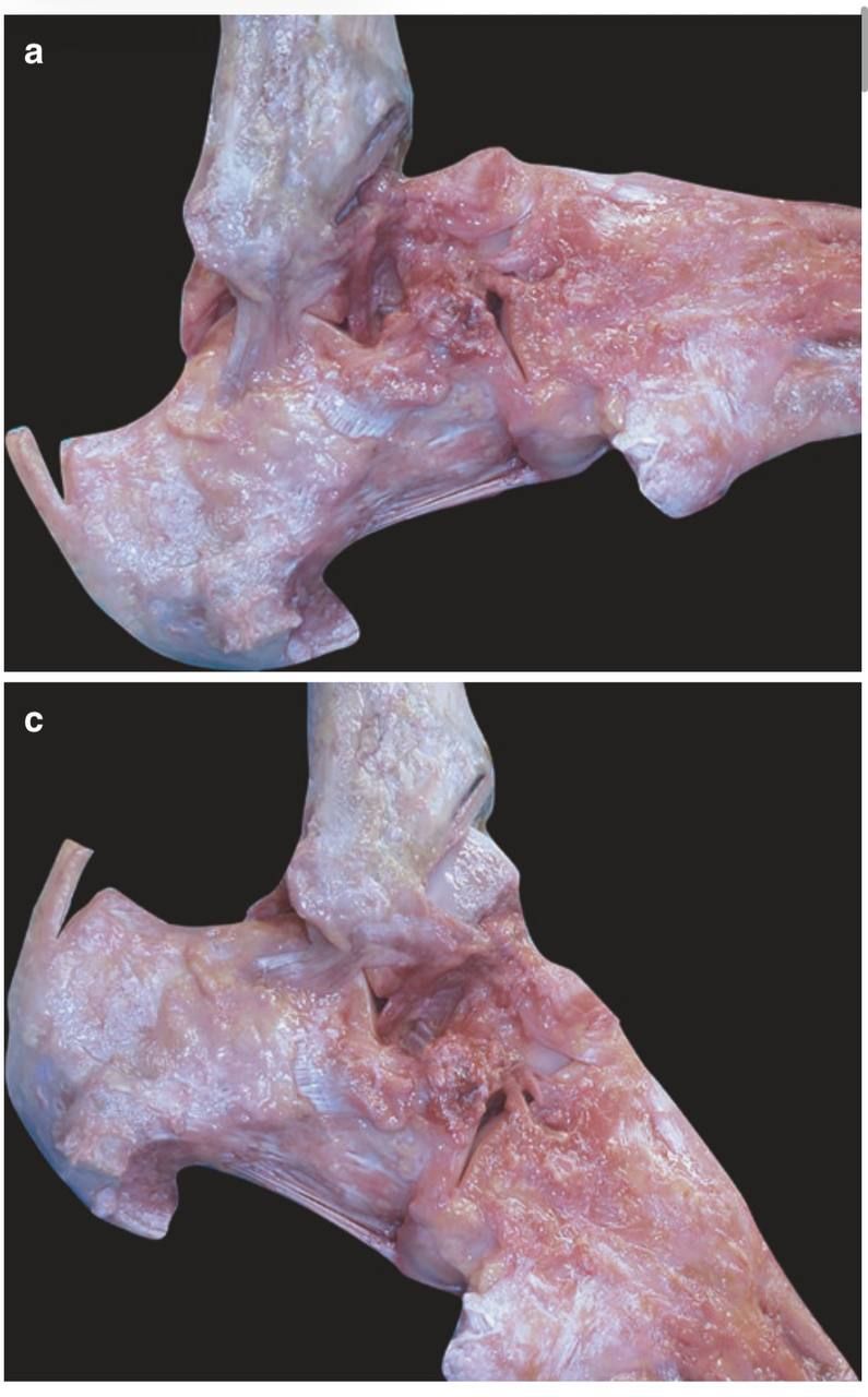 Натяжение связок при тыльном и подошвенном сгибании