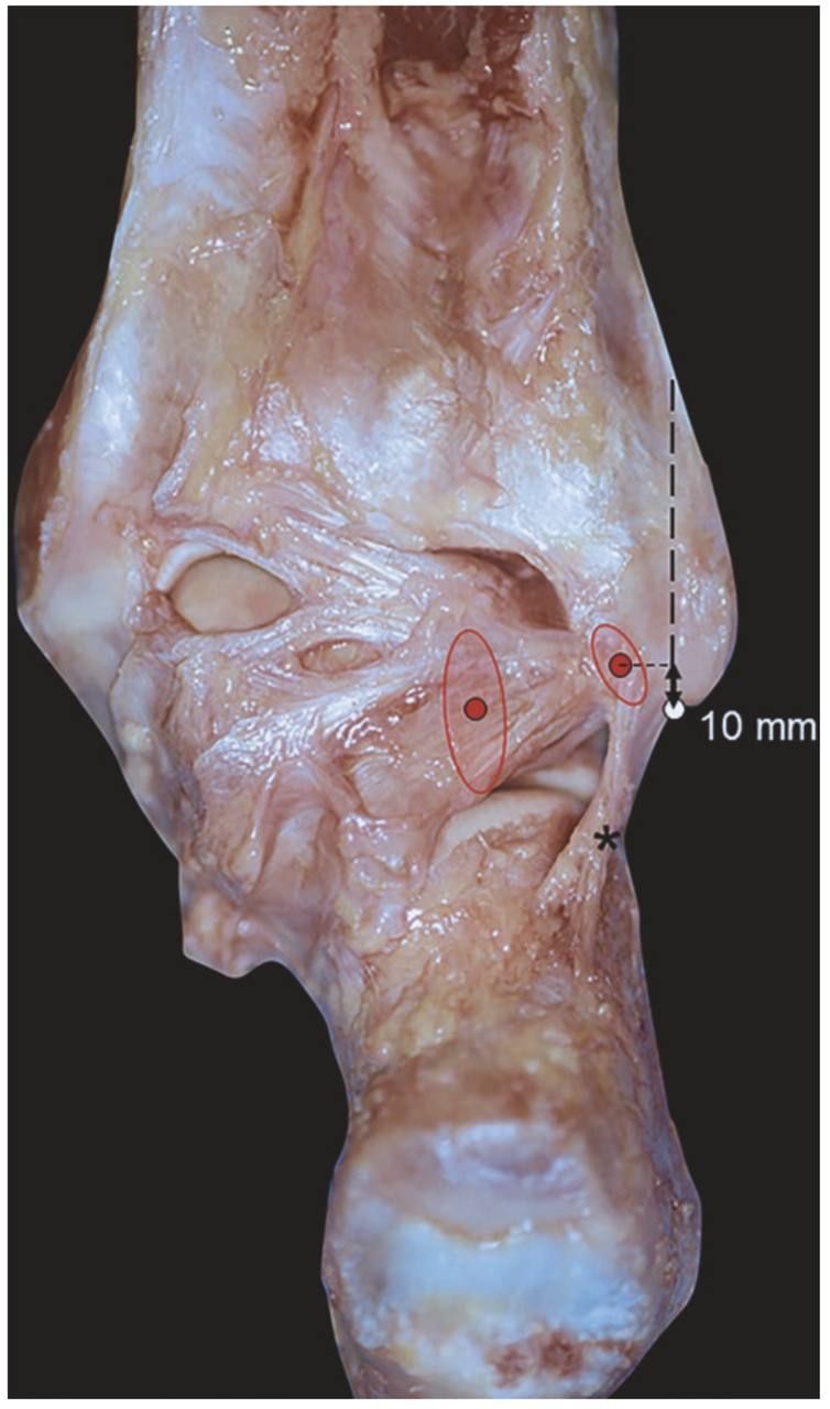 Задняя таранно-малоберцовая связка (PTFL)