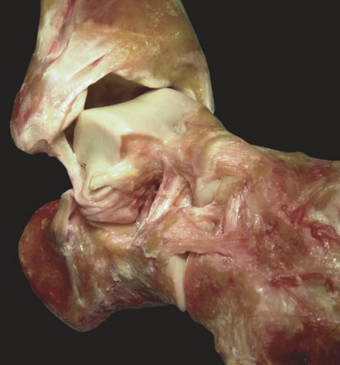 Варусный наклон и экструзия таранной кости