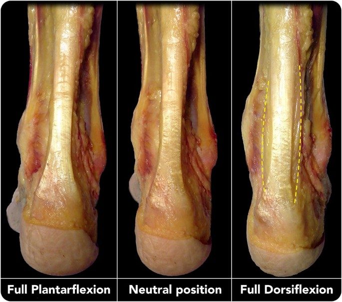 Рис. 3. Ахиллово сухожилие в зависимости от положения стопы