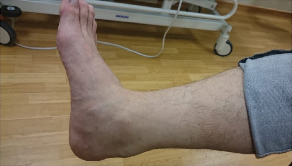 Рис. 4. Внешний вид неинсерционной тендинопатии ахиллова сухожилия: веретенообразное утолщение средней трети сухожилия