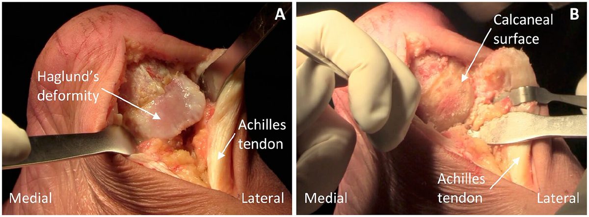 Рис. 6. Деформация Хаглунда: клинический вид