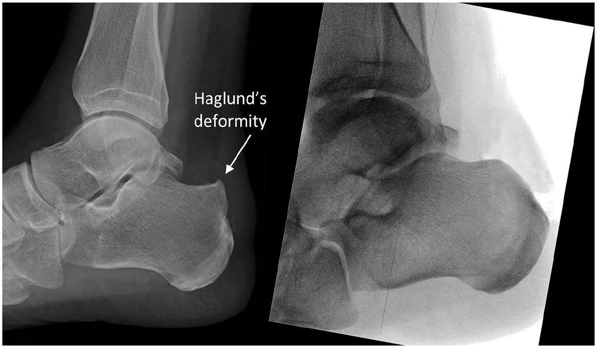 Рис. 7. Деформация Хаглунда: рентгенограмма