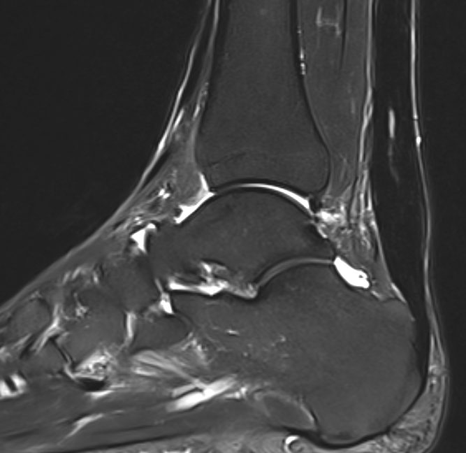 Рис. 5. МРТ неинсерционной тендинопатии ахиллова сухожилия: повышение сигнала в средней порции