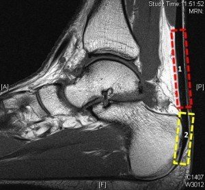 Рис. 1. МРТ: разделение инсерционной (жёлтый) и неинсерционной (красный) тендинопатии ахиллова сухожилия