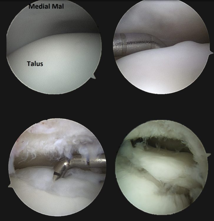 Рис. 9. Артроскопический вид различных стадий остеохондральных повреждений таранной кости