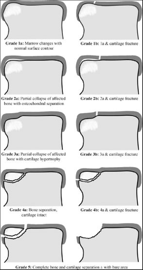 Рис. 3. МРТ-классификация остеохондральных повреждений по Hepple (1999)