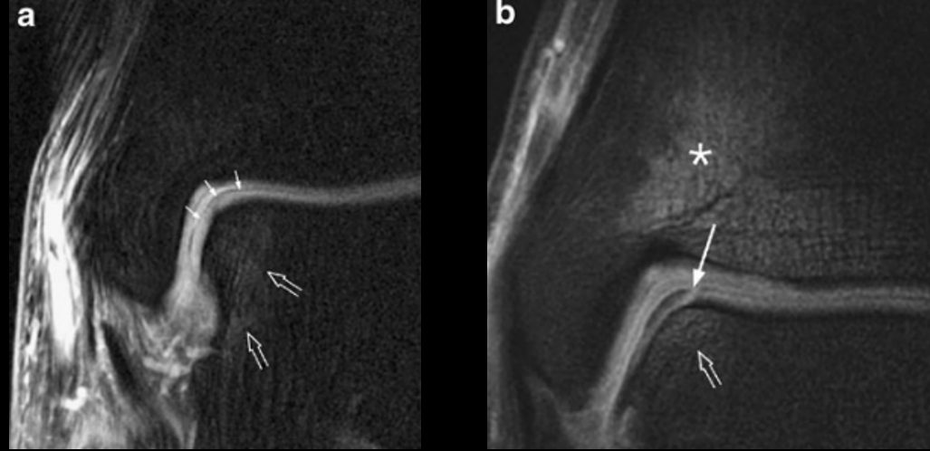 Рис. 4. МРТ: стадии 1а и 1б — повреждение хряща без (1а) и с (1б) вовлечением субхондральной кости