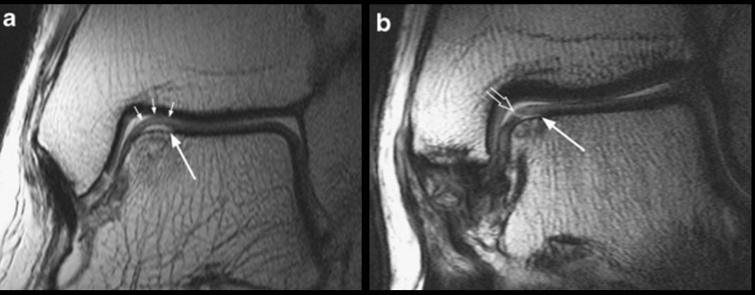 Рис. 5. МРТ: стадии 2а и 2б — субхондральный перелом с отёком костного мозга (2а) и без отёка (2б, хроническое повреждение)
