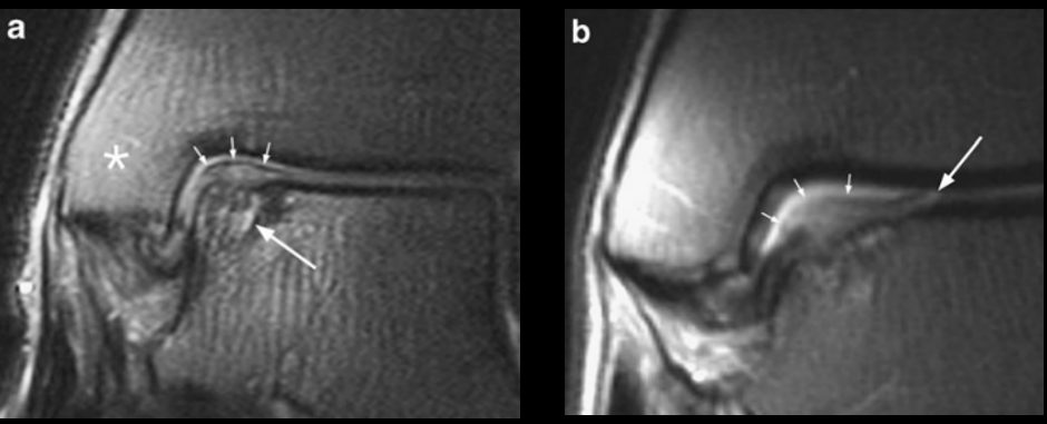 Рис. 6. МРТ: стадии 3а и 3б — отделённый, но не смещённый фрагмент
