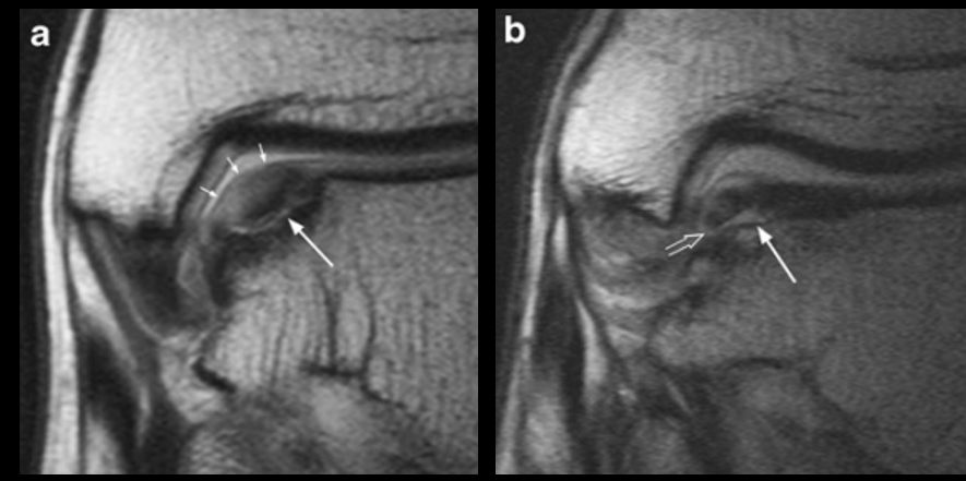Рис. 7. МРТ: стадии 4а и 4б — смещённый остеохондральный фрагмент