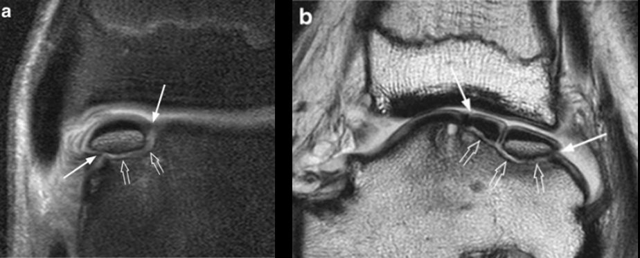 Рис. 8. МРТ: стадии 5а и 5б — субхондральная киста (хроническое повреждение)