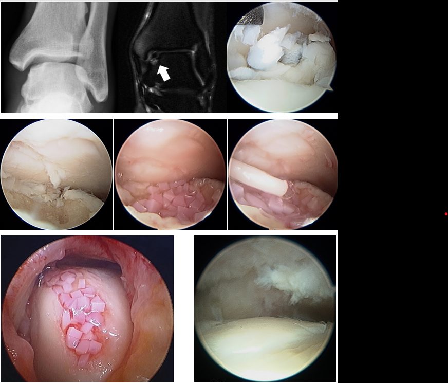 Рис. 15. Микрофрактурирование с пластикой аллогенным хрящом и использованием геля