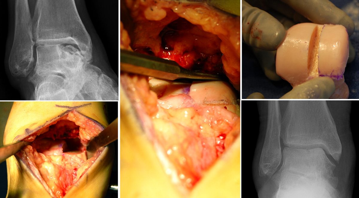Рис. 16. Остеохондропластика из свежезамороженной таранной кости