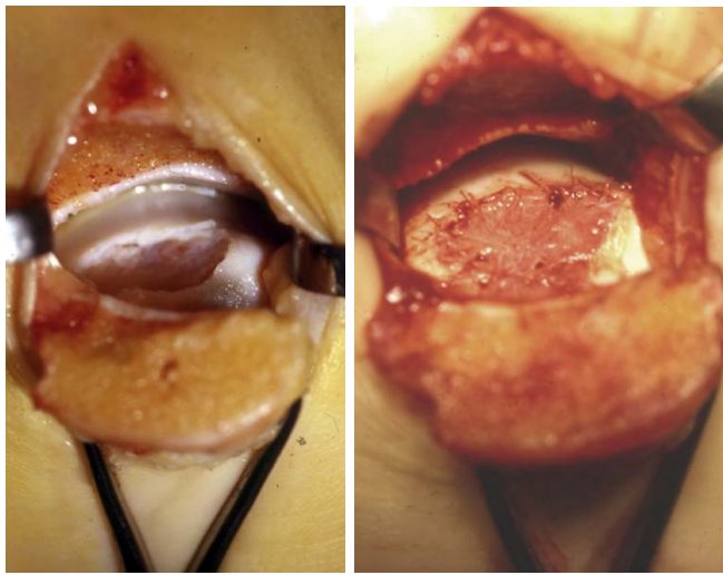 Рис. 11. Закрытие дефекта коллагеновой мембраной (AMIC)
