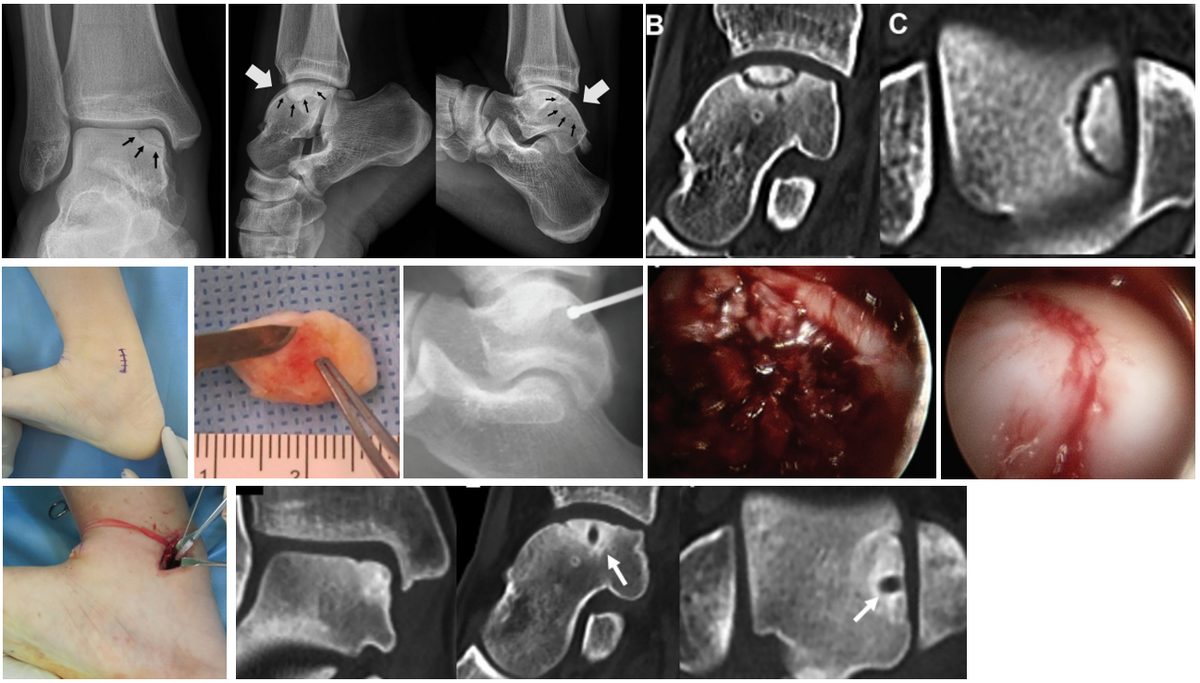 Рис. 13. Рефиксация остеохондрального фрагмента