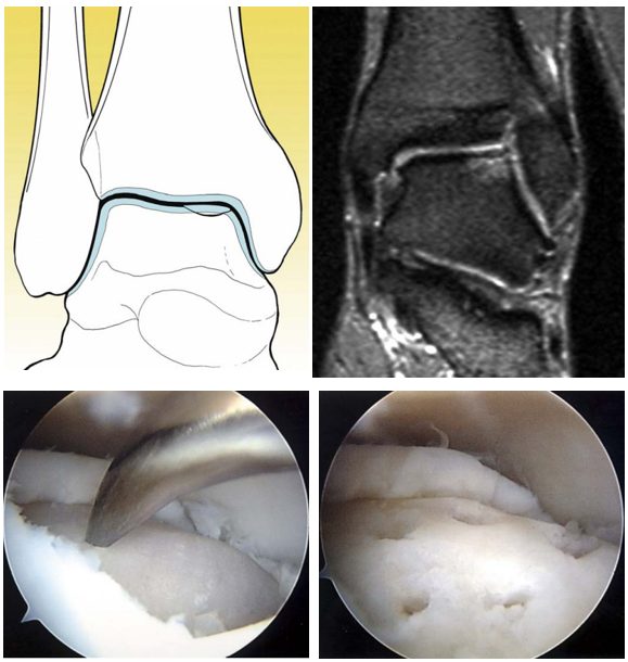 Рис. 10. Артроскопическое микрофрактурирование субхондральной пластинки