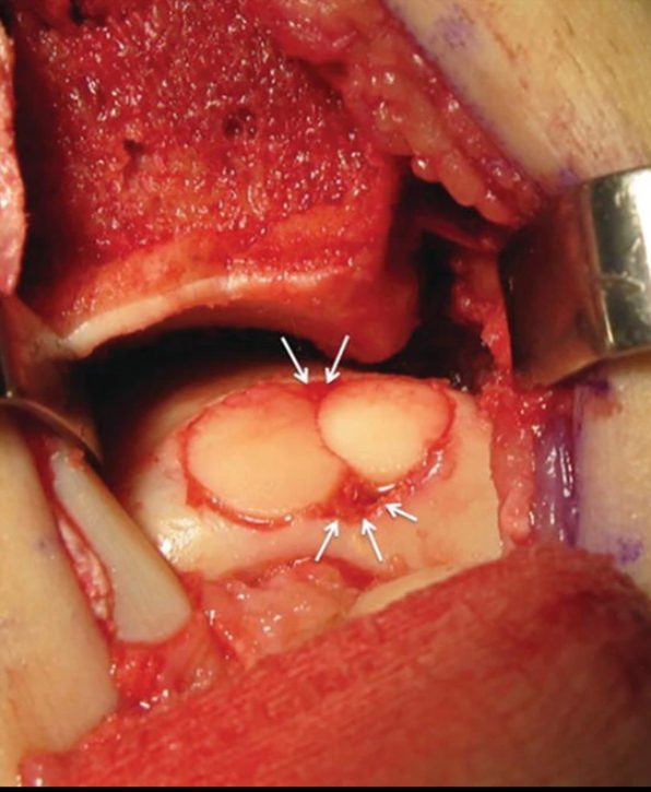 Рис. 12. Мозаичная остеохондропластика (OATS) — пересадка остеохондральных цилиндров