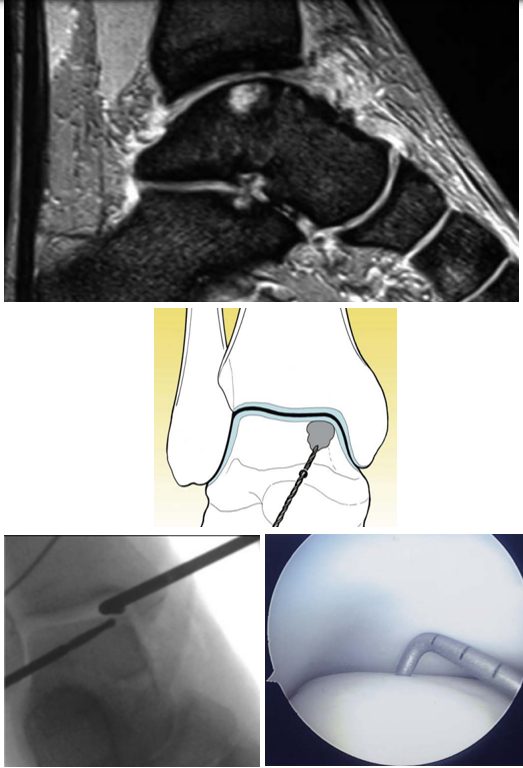 Рис. 14. Ретроградная туннелизация таранной кости