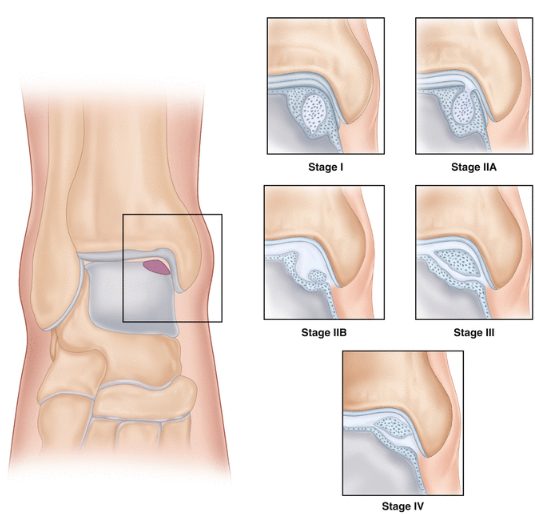 Рис. 2. Рентгенологическая классификация остеохондральных повреждений таранной кости по Berndt и Harty (1959)