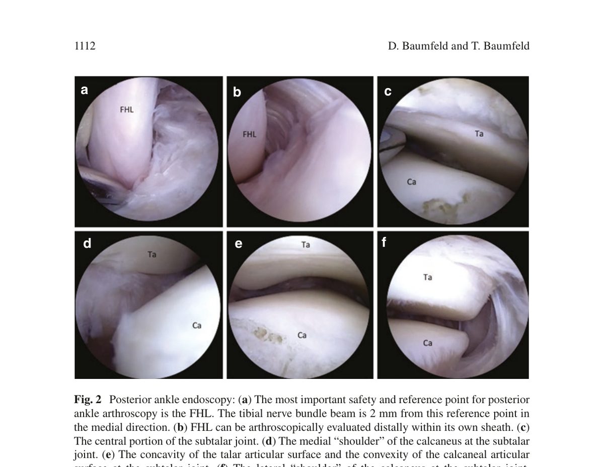 Рис. 2. Эндоскопическая анатомия заднего отдела голеностопного сустава: (a) сухожилие FHL - основной ориентир безопасности; (b) FHL в собственном влагалище; (c) центральная часть подтаранного сустава; (d) медиальное «плечо» пяточной кости; (e) вогнутость суставной поверхности таранной кости и выпуклость пяточной; (f) латеральное «плечо» пяточной кости. FHL - сухожилие длинного сгибателя большого пальца, Ta - таранная кость, Ca - пяточная кость. Адаптировано из Wagner, 2022