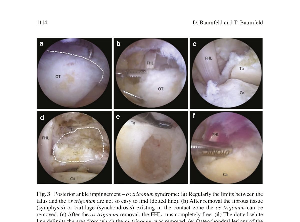 Рис. 3. Эндоскопическое удаление os trigonum: (a) граница между таранной костью и os trigonum (пунктирная линия); (b) удаление фиброзной ткани синхондроза; (c) свободное скольжение FHL после удаления os trigonum; (d) зона резекции; (e) остеохондральное повреждение задней поверхности таранной кости - доступно из заднего доступа; (f) низкое прикрепление брюшка FHL как причина импиджмента. OT - os trigonum, FHL - длинный сгибатель большого пальца, Ta - таранная кость, Ca - пяточная кость. Адаптировано из Wagner, 2022