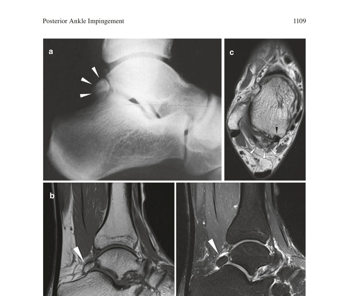 Рис. 1. МРТ заднего отдела голеностопного сустава при синдроме os trigonum: (a) сагиттальный срез - os trigonum (стрелки); (b) сагиттальные T1- и T2-взвешенные изображения; (c) аксиальный срез - os trigonum (белые стрелки), сухожилие FHL (чёрная стрелка), сосудисто-нервный пучок (пунктирная линия). Адаптировано из Wagner, 2022