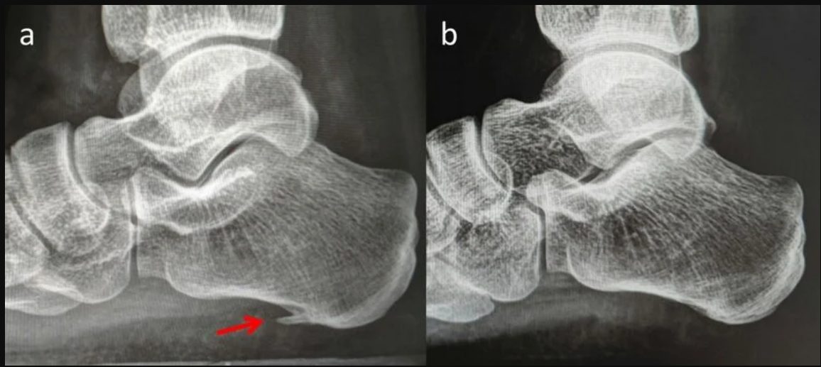 Рис. 4. Рентгенограммы: А — пяточная шпора, В — без пяточной шпоры