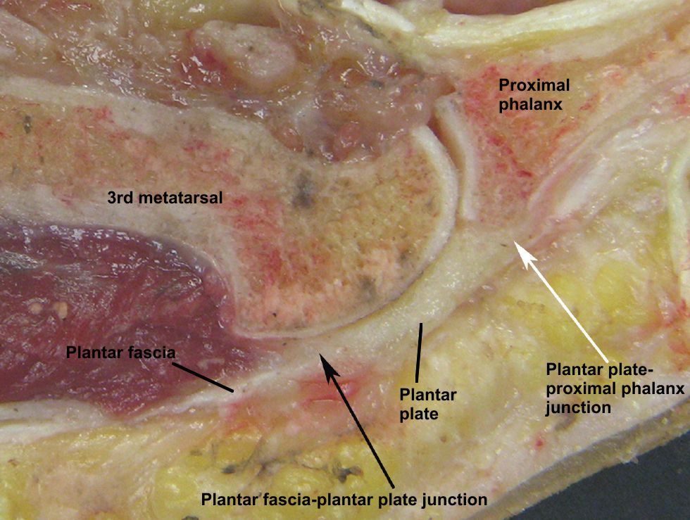 Рис. 2. Конвергенция подошвенной фасции с капсулой плюснефалангового сустава и плантарной пластинкой