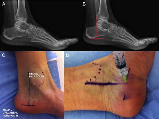 Рис. 9. Техника выполнения инъекций в подошвенный апоневроз