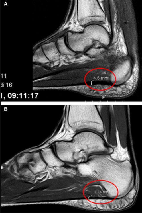 Рис. 5. МРТ: А — пациент с подошвенным фасциитом (утолщение фасции, повышение сигнала), В — здоровый пациент